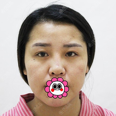 之前一直打玻尿酸这次选择天津圣韩美柴炀栋做的眼鼻综合和面填
