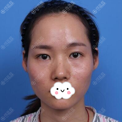 专门找长沙湘美汇解西吴东辉做自体脂肪面部填充果然没让我失望