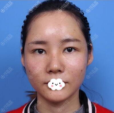 吴东辉全面部脂肪填充术后4天效果 吴东辉全面部脂肪填充术后4天效果