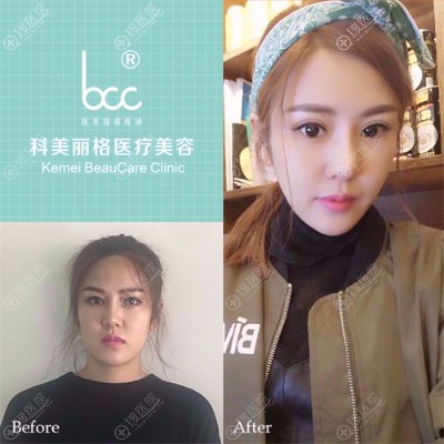 <!--<i data=20240710 data-id=8404></i>--><!--<i data=20240710 data-id=16713></i>-->做的面部脂肪填充案例 <!--<i data=20240710 data-id=8404></i>--><!--<i data=20240710 data-id=16713></i>-->做的面部脂肪填充案例