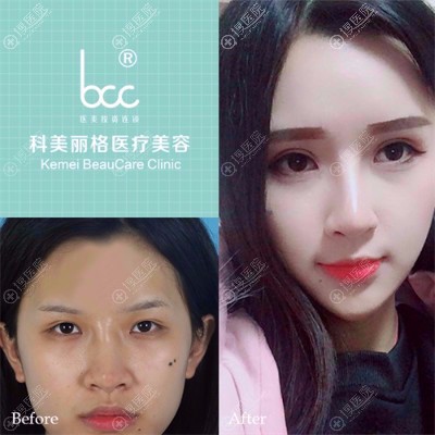 <!--<i data=20240710 data-id=8404></i>--><!--<i data=20240710 data-id=16713></i>-->做的双眼皮案例 <!--<i data=20240710 data-id=8404></i>--><!--<i data=20240710 data-id=16713></i>-->做的双眼皮案例