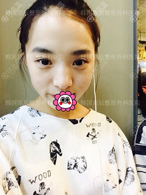到韩国原辰做了鼻综合后效果不错,又去做了面部脂肪填充