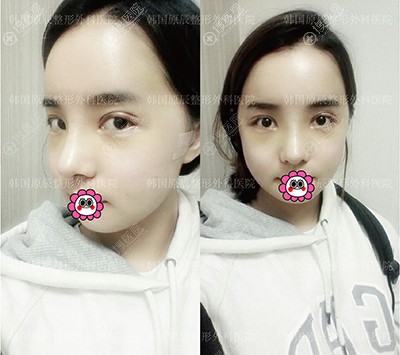 术后恢复一周到医院拆线效果 术后恢复一周到医院拆线效果