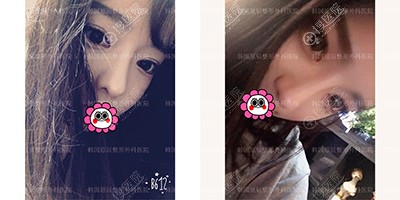 韩国原辰隆鼻双眼皮术后恢复效果怎么样? 韩国原辰隆鼻双眼皮术后恢复效果怎么样?