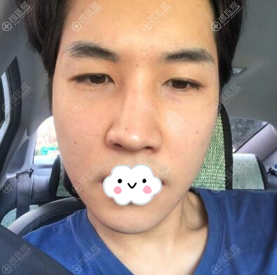 韩国NANA整形医院金亨俊院长双眼皮提肌+鼻修复手术案例效果图