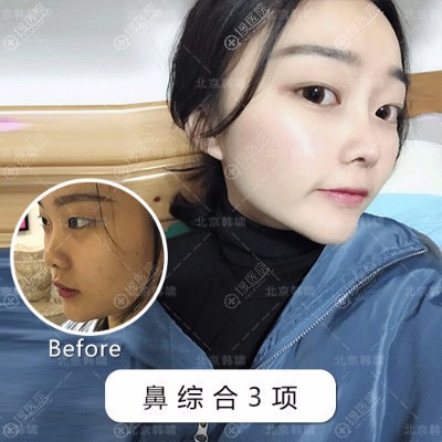 <!--<i data=20240710 data-id=12082></i>-->郑栋宇医生隆鼻<span style= <!--<i data=20240710 data-id=12082></i>-->郑栋宇医生隆鼻<span style=