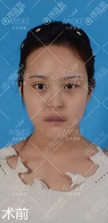 北京美莱做双眼皮修复手术前 北京美莱做双眼皮修复手术前
