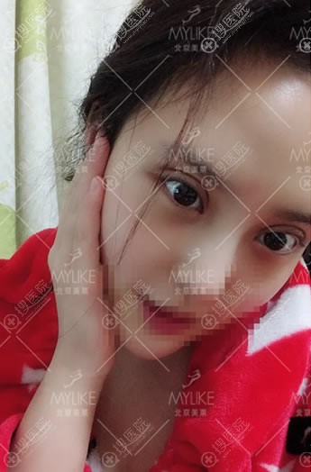 北京美莱做双眼皮修复案例即刻效果 北京美莱做双眼皮修复案例即刻效果