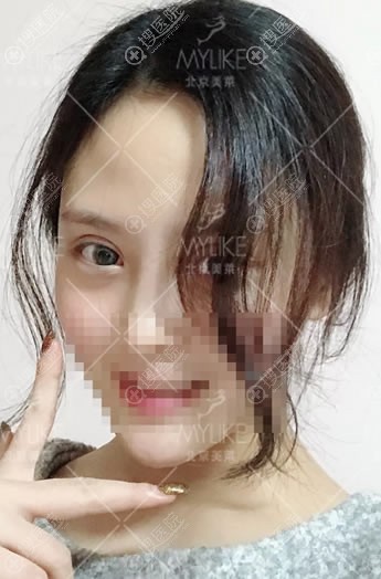 北京美莱割双眼皮案例15天效果 北京美莱割双眼皮案例15天效果