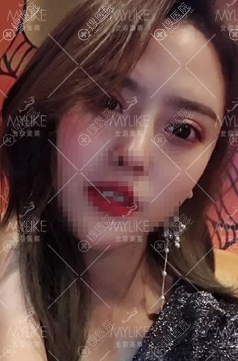 北京美莱刘金华双眼皮修复案例 北京美莱刘金华双眼皮修复案例