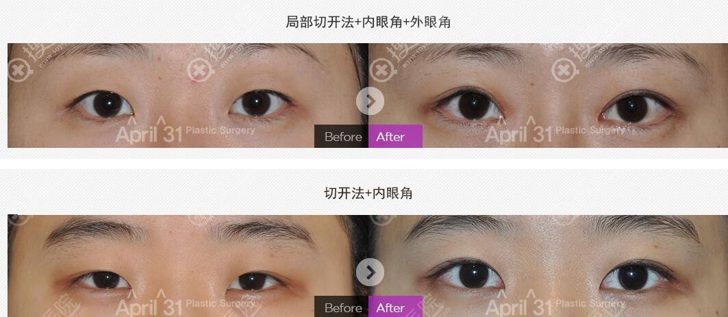 吴原硕眼部修复案例 吴原硕眼部修复案例