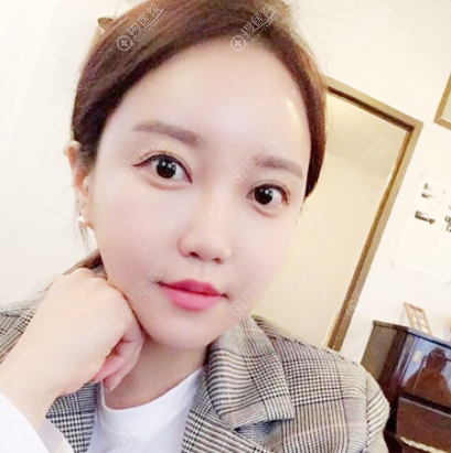 上海丽质卢九宁做的脂肪填充全脸案例 上海丽质卢九宁做的脂肪填充全脸案例
