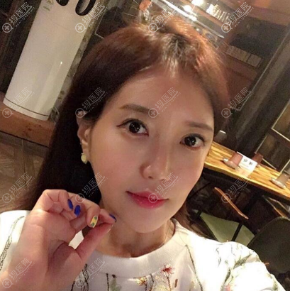 在上海丽质做脂肪填充前的样子 在上海丽质做脂肪填充前的样子