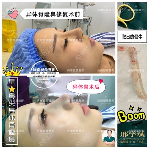 <!--<i data=20240710 data-id=11897></i>-->整形邢学斌鼻修复案例 <!--<i data=20240710 data-id=11897></i>-->整形邢学斌鼻修复案例