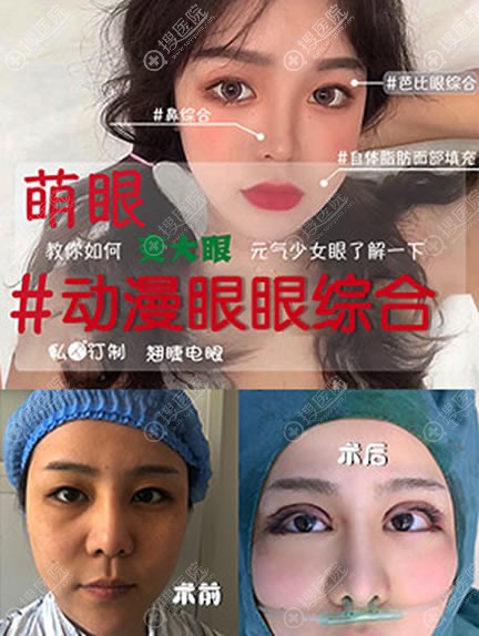 <!--<i data=20240710 data-id=11897></i>-->整形邢学斌双眼皮案例 <!--<i data=20240710 data-id=11897></i>-->整形邢学斌双眼皮案例