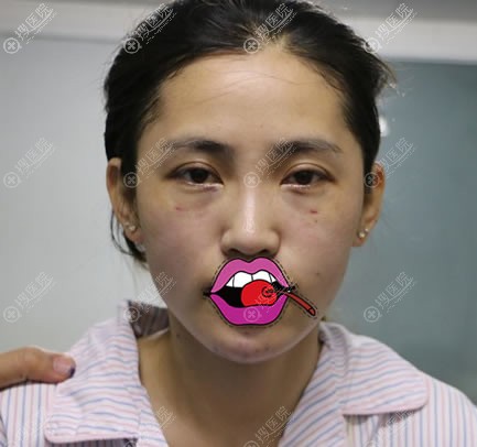 北京京民医院脂肪填充和隆下巴即刻效果 北京京民医院脂肪填充和隆下巴即刻效果