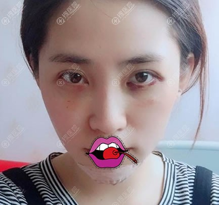 做完垫下巴和自体脂肪填充3天后 做完垫下巴和自体脂肪填充3天后