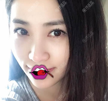 假体隆下巴和脂肪填充面颊案例 假体隆下巴和脂肪填充面颊案例