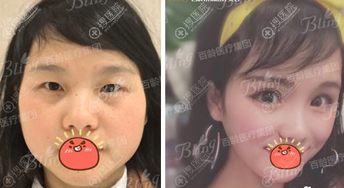 <!--<i data=20240710 data-id=11896></i>-->美整形做双眼皮案例 <!--<i data=20240710 data-id=11896></i>-->美整形做双眼皮案例
