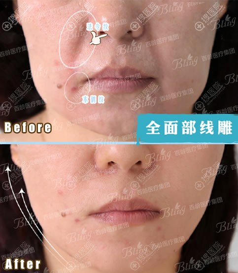 <!--<i data=20240710 data-id=11896></i>-->美整形李莉院长面部线雕案例 <!--<i data=20240710 data-id=11896></i>-->美整形李莉院长面部线雕案例