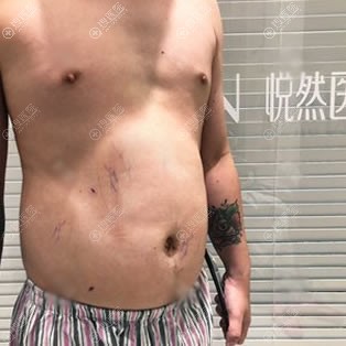 <!--<i data=20240710 data-id=11941></i>-->医美腹部吸脂7天效果 <!--<i data=20240710 data-id=11941></i>-->医美腹部吸脂7天效果