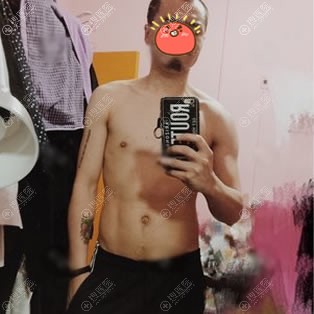 <!--<i data=20240710 data-id=11941></i>-->李京霖腹部吸脂案例 <!--<i data=20240710 data-id=11941></i>-->李京霖腹部吸脂案例