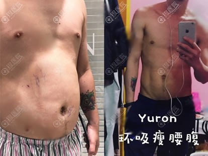 <!--<i data=20240710 data-id=11941></i>-->腰腹部吸脂案例对比图 <!--<i data=20240710 data-id=11941></i>-->腰腹部吸脂案例对比图
