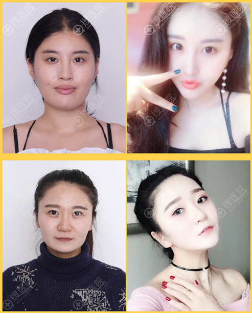 上海伊莱美李湘原做的颧骨下颌角磨骨案例 上海伊莱美李湘原做的颧骨下颌角磨骨案例