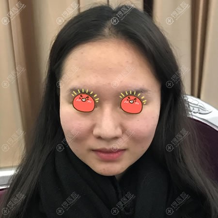 �ҵ�СV����ͨ���ڱ������������沿��֬����������,���˺ü���