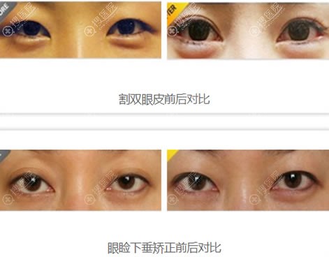 <!--<i data=20240710 data-id=8077></i>-->美容医院割双眼皮案例 <!--<i data=20240710 data-id=8077></i>-->美容医院割双眼皮案例
