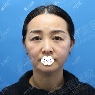 <!--<i data=20240710 data-id=12503></i>-->线雕提升术前照片 <!--<i data=20240710 data-id=12503></i>-->线雕提升术前照片