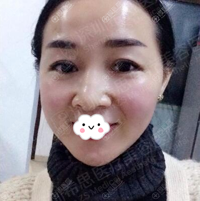<!--<i data=20240710 data-id=12503></i>-->余永刚线雕术后即刻效果 <!--<i data=20240710 data-id=12503></i>-->余永刚线雕术后即刻效果