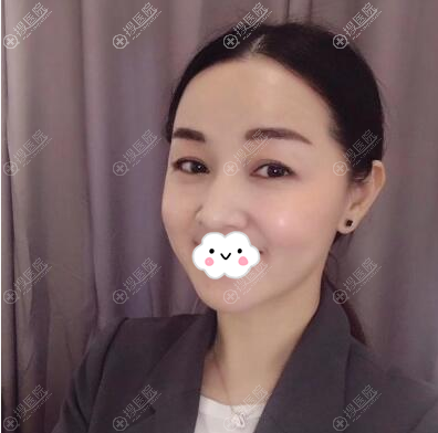 <!--<i data=20240710 data-id=12503></i>-->余永刚线雕术后4个月效果图 <!--<i data=20240710 data-id=12503></i>-->余永刚线雕术后4个月效果图