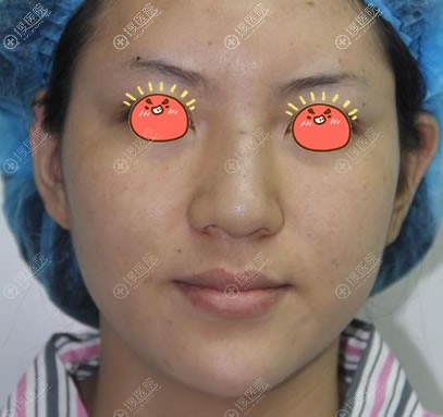 西安新鹏爱悦己医疗美容刘晨做肋软骨鼻综合隆鼻真人案例出炉