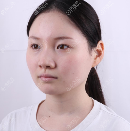 不想做面部吸脂就去上海华美找何斌做了射频溶脂瘦脸效果还不错