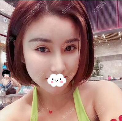 深圳丽港丽格李虎面部脂肪填充术后效果 深圳丽港丽格李虎面部脂肪填充术后效果