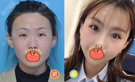 沈阳腾采杨庆峰双眼皮修复案例 沈阳腾采杨庆峰双眼皮修复案例