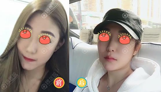 沈阳腾采孟强鼻综合隆鼻案例 沈阳腾采孟强鼻综合隆鼻案例