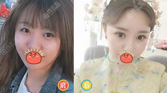 沈阳腾采整形侯莉割双眼皮案例 沈阳腾采整形侯莉割双眼皮案例