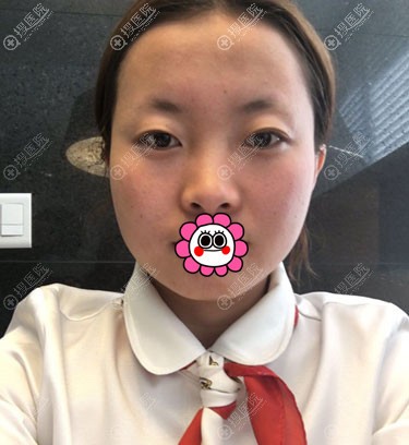 做眼鼻综合整形前照片 做眼鼻综合整形前照片