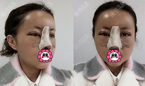 眼鼻综合整形恢复后6天 眼鼻综合整形恢复后6天