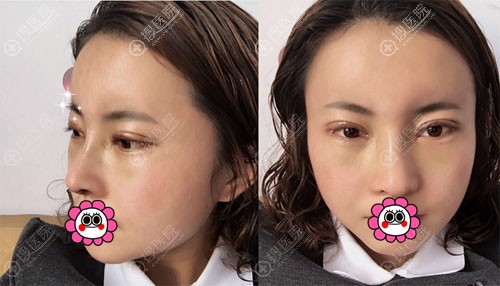 眼鼻综合术后十天效果 眼鼻综合术后十天效果