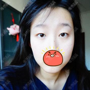 选择曲靖靖美整形医院杨富春做9mm大宽双眼皮和开眼角1月恢复图