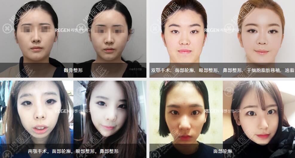 韩国丽珍医生团队蜕变前后案例 韩国丽珍医生团队蜕变前后案例