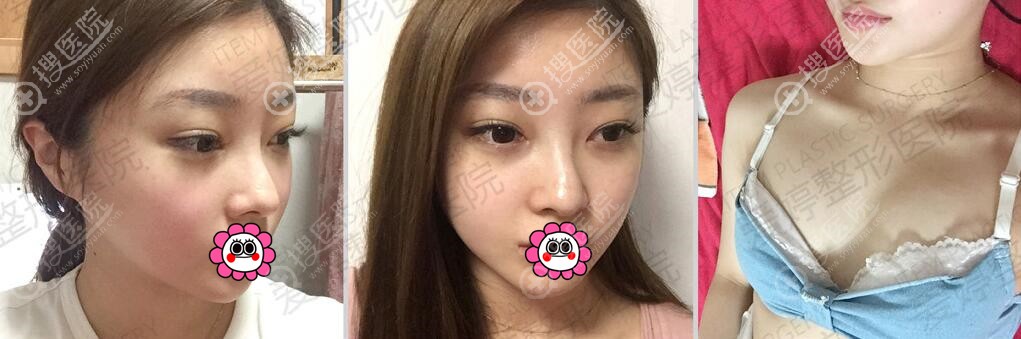 韩国爱婷整形哪个院长做鼻子好?我的鼻修复和丰胸是找吴珉做的