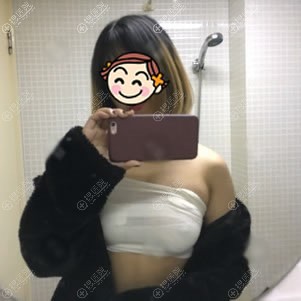做完曼托假体隆胸手术3天效果 做完曼托假体隆胸手术3天效果