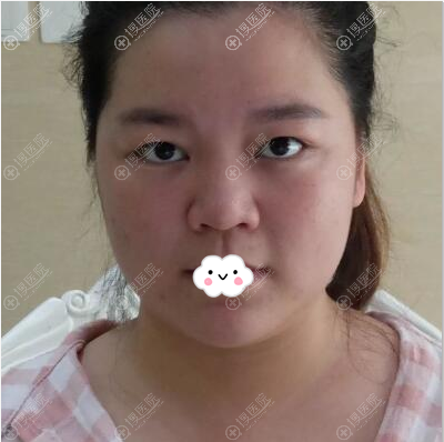 深圳伊婉整形医院王力佳给我做的面部吸脂瘦脸手术效果堪比磨骨