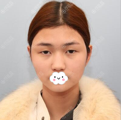 内向的我找深圳希思医院李俊做了眼综合和膨体隆下巴后变自信了