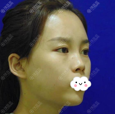 找深圳米兰柏羽朱武根做肋软骨隆鼻一个月看到效果分享我的心情