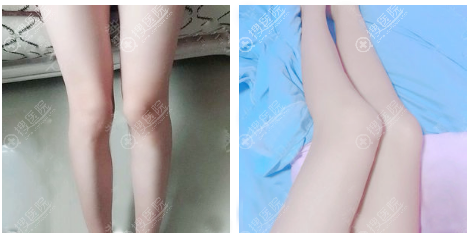 高一生金磊大腿抽脂案例一个月恢复效果 高一生金磊大腿抽脂案例一个月恢复效果